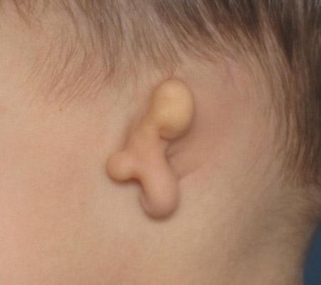 先天性耳畸形手术后要注意哪些