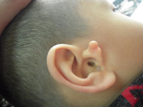 耳畸形手术贵吗